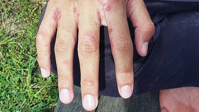 4. Hausse de la gale